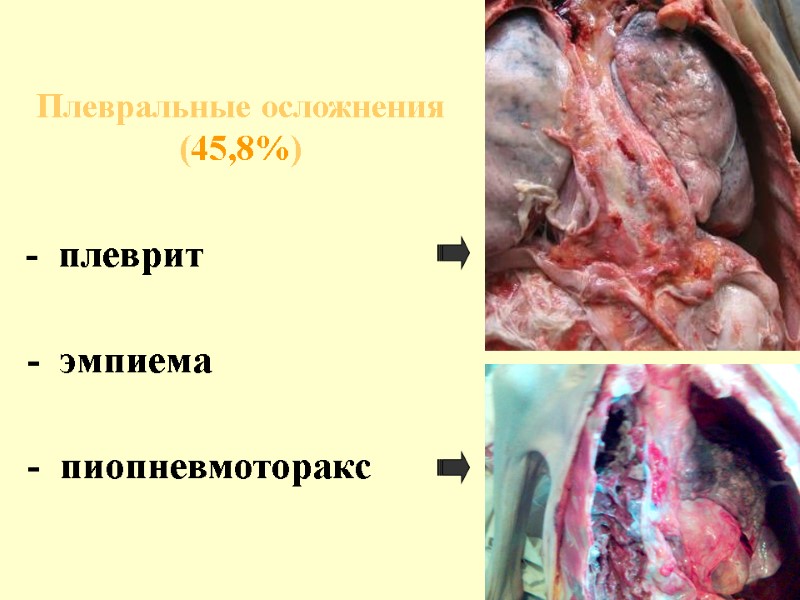 Плевральные осложнения (45,8%)      -  плеврит   